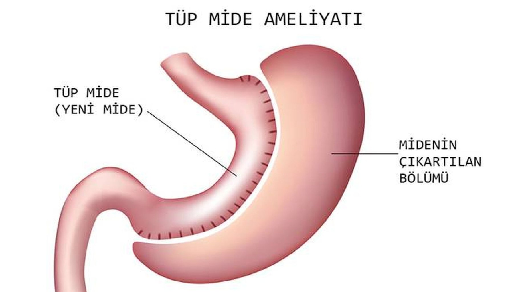 Kol mədə əməliyyatı