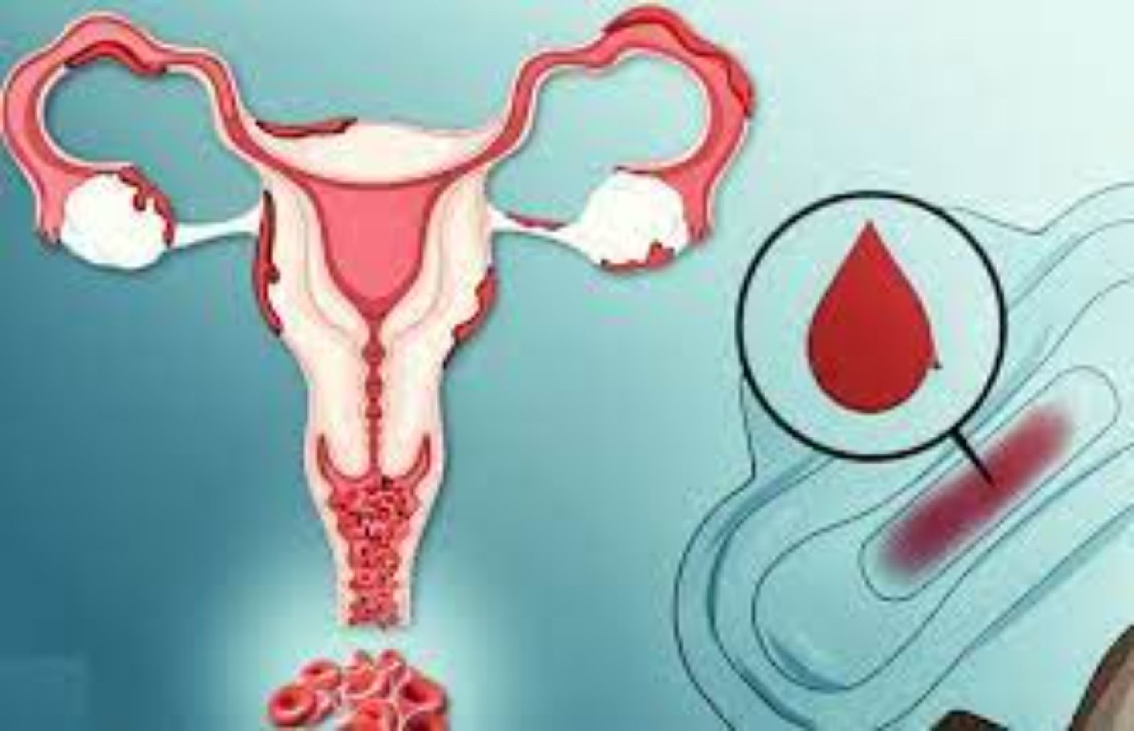 Uşaqlıq yolundan qanaxma