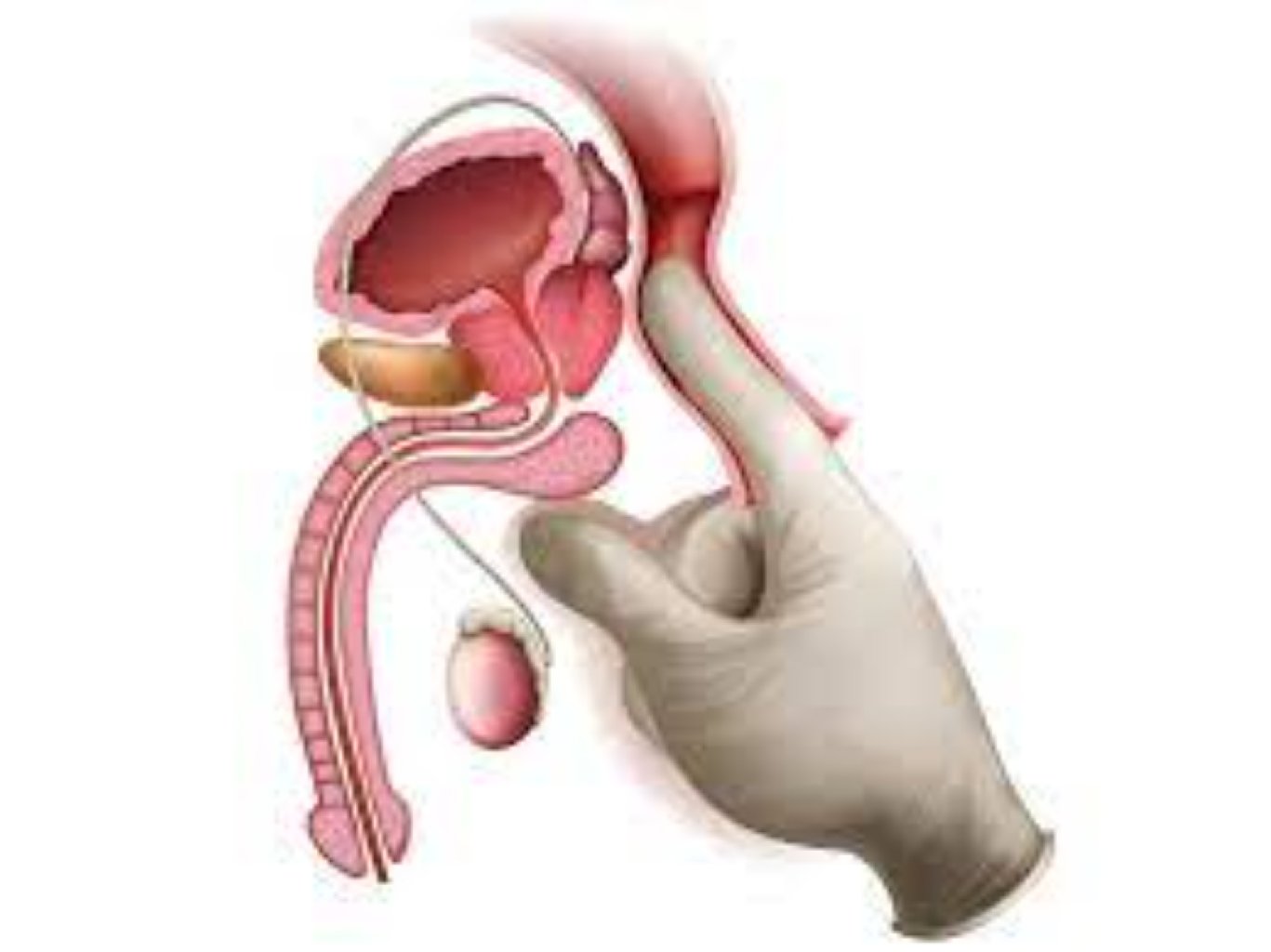 Prostat vezinin absesi