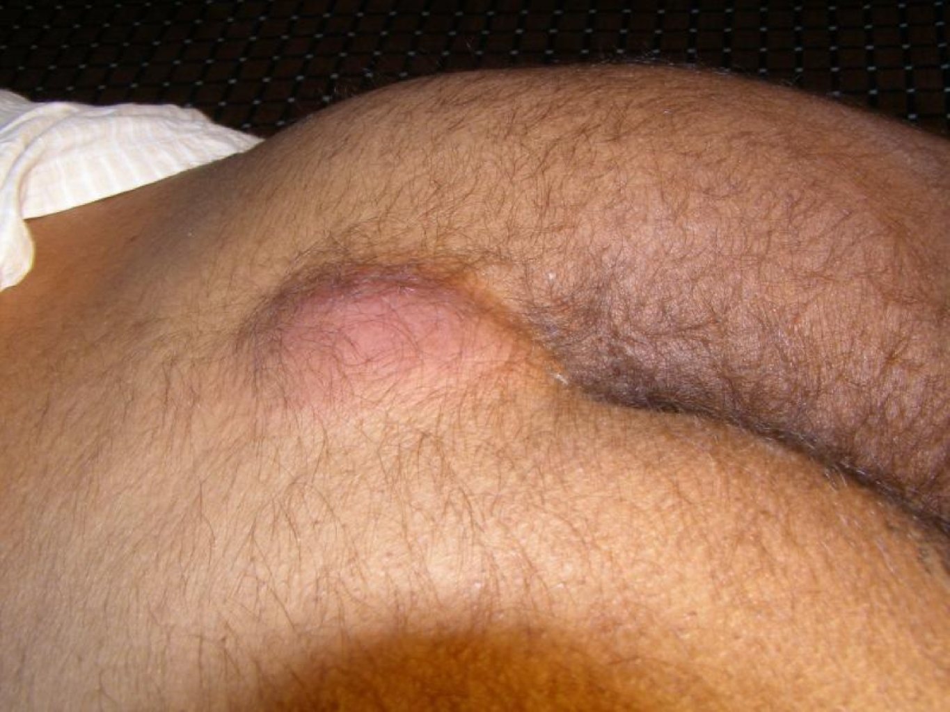 Büzdüm Kistası(Pilonidal Sinüs): Tərif, Səbəbləri və Müalicə Yolları