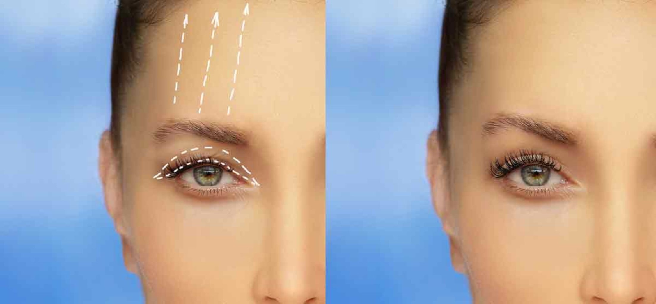 Göz qapaqlarının estetikası haqqında məlumat makalesi