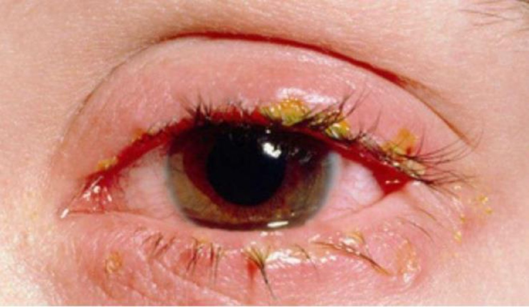 Adenovirus konyunktiviti