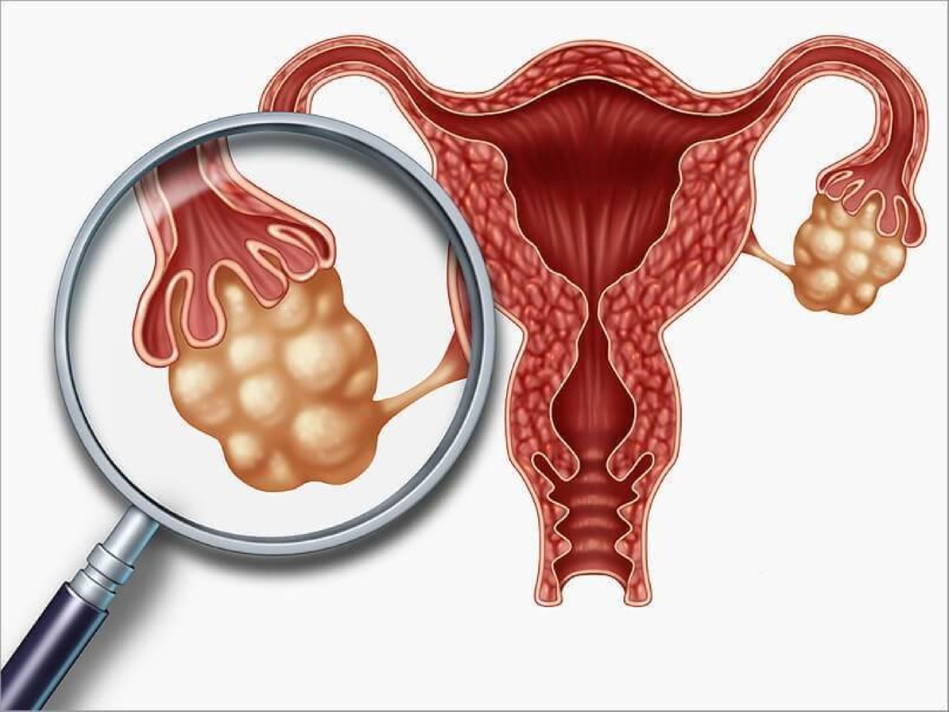 Yumurtalıqların polikistozu