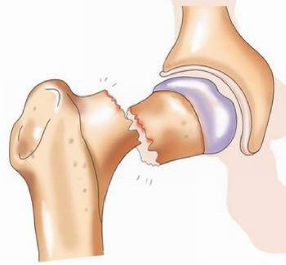 Sınıqların Müalicəsi və Təqibi