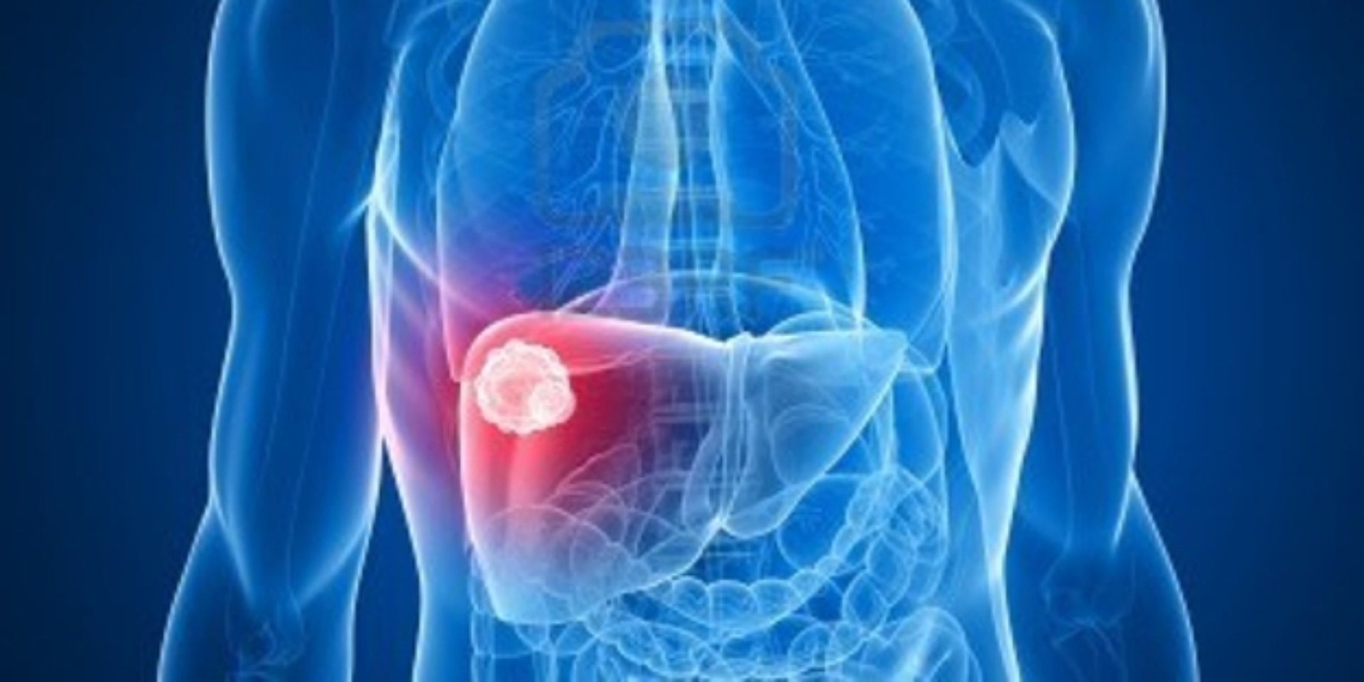 Qara qaraciyər xəstəliyi-simptomlar, səbəblər, diaqnoz və müalicə