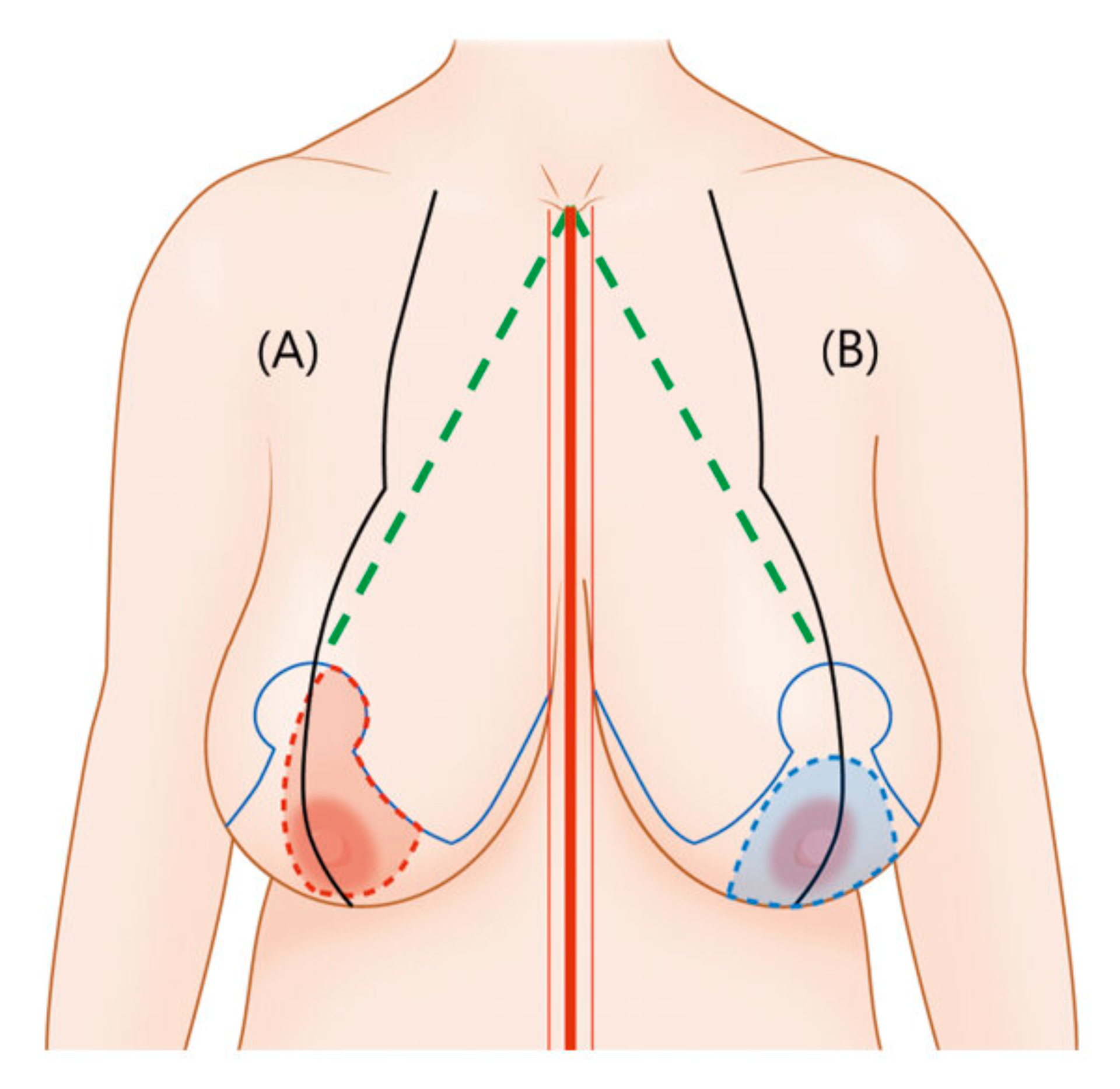 Mamoplastika - Sinə əməliyyatı makalesi