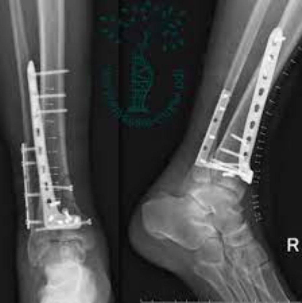 Osteosintezın bütün növləri