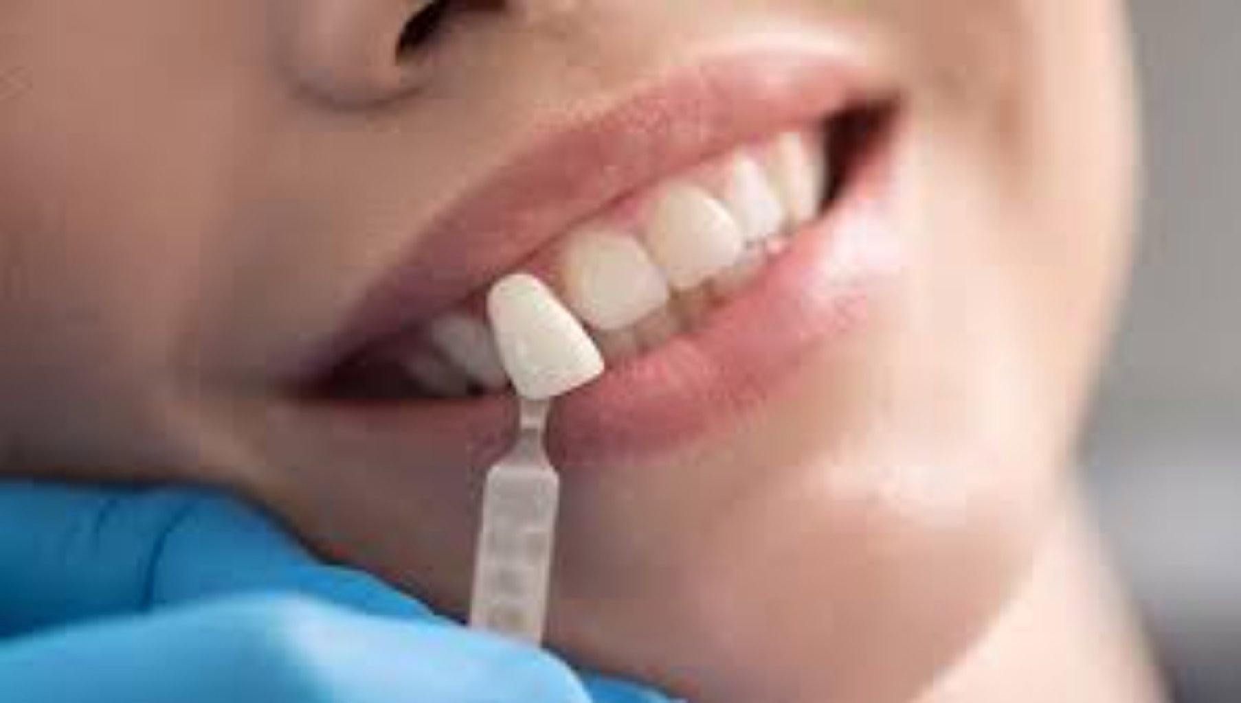 Zirkon və metal keramik qapaqlar