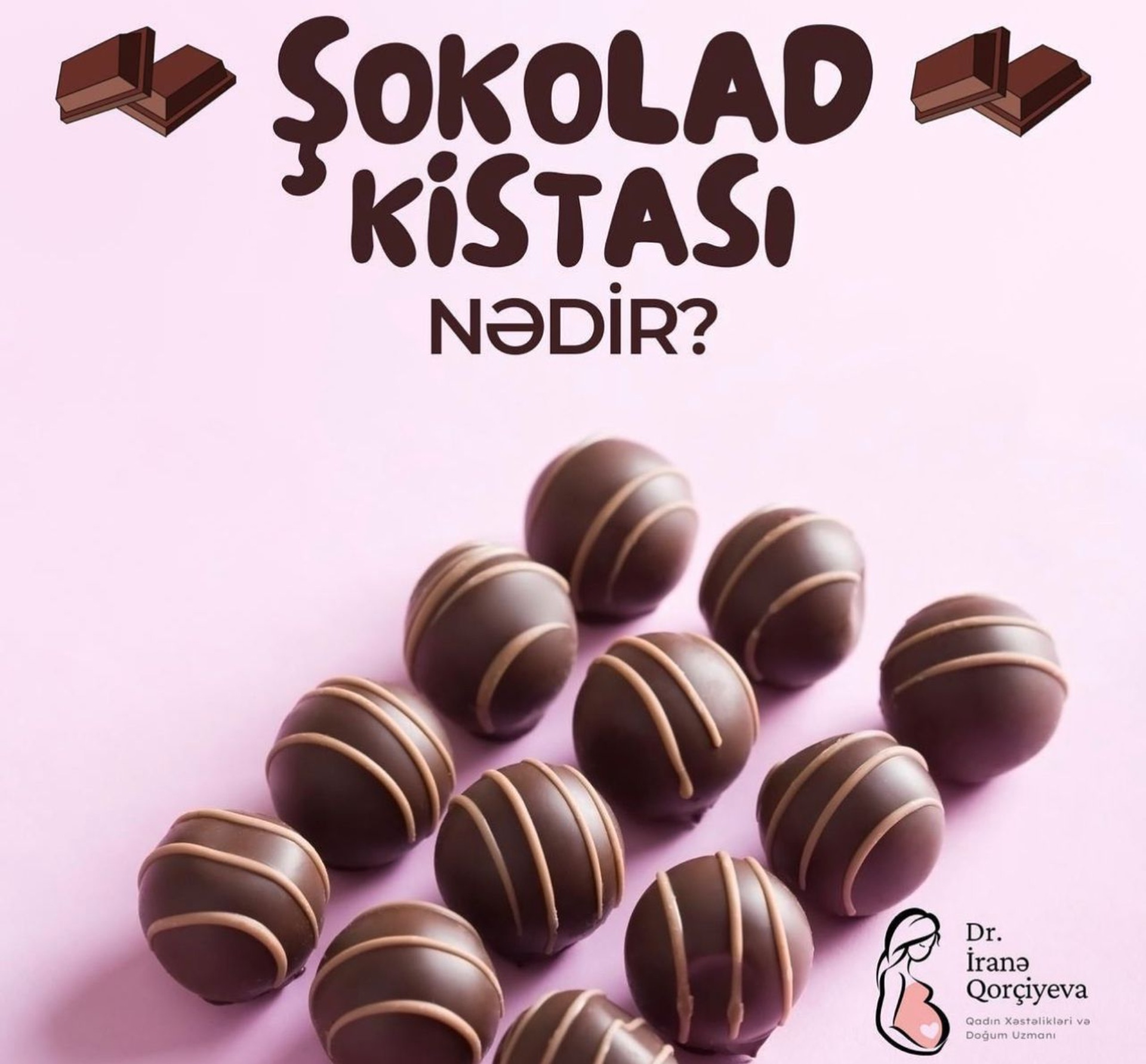 Şokolad Kisti Nədir? makalesi