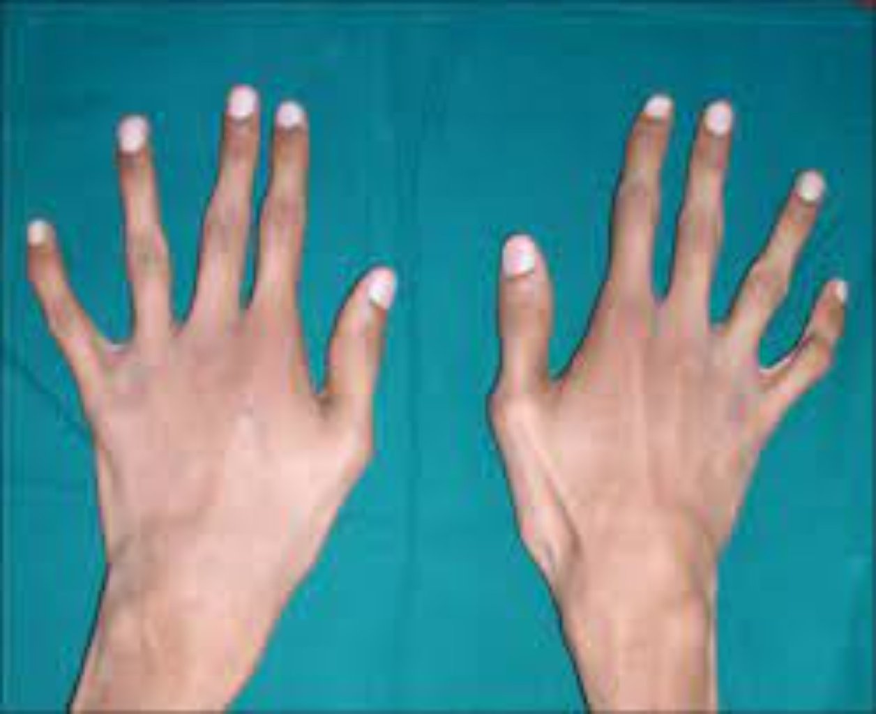 Araxnodaktiliya haqqında