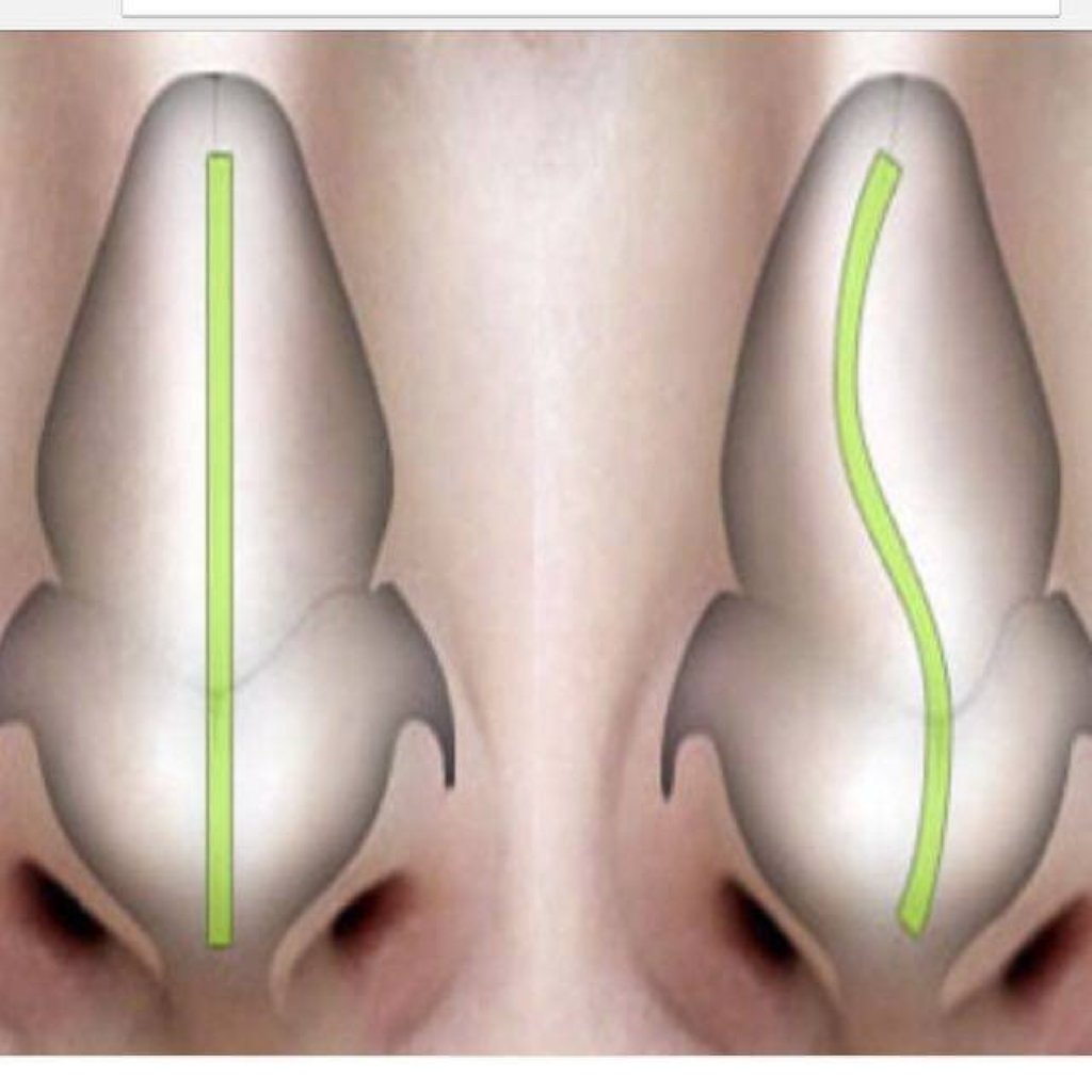 Burun çəpəri əyriliyi