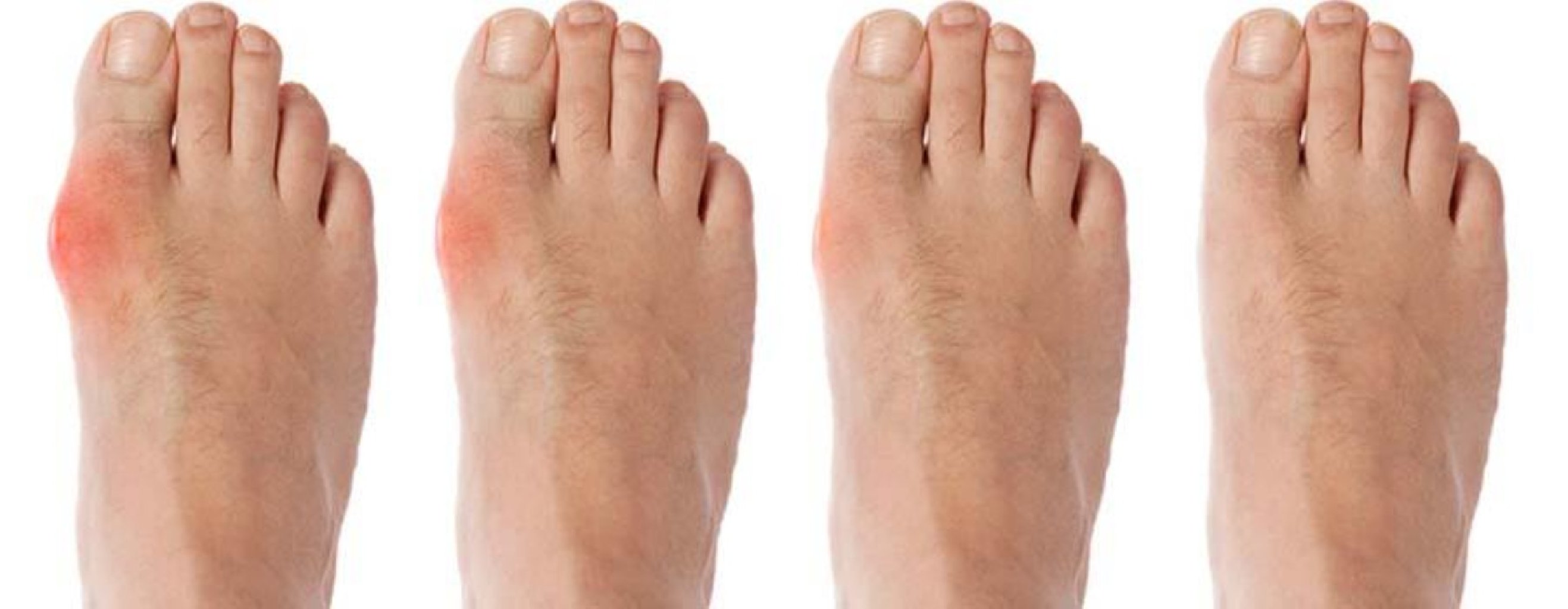 Hallux valgus haqqında