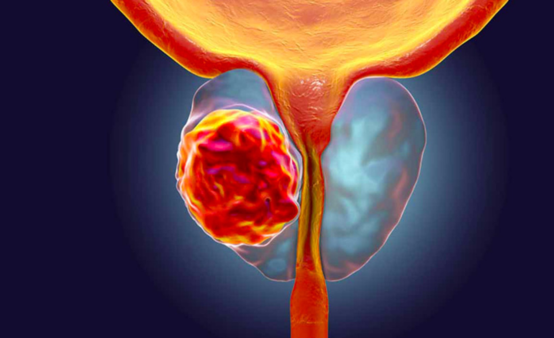 Prostat xərçəngi necə müalicə edilməlidir? makalesi