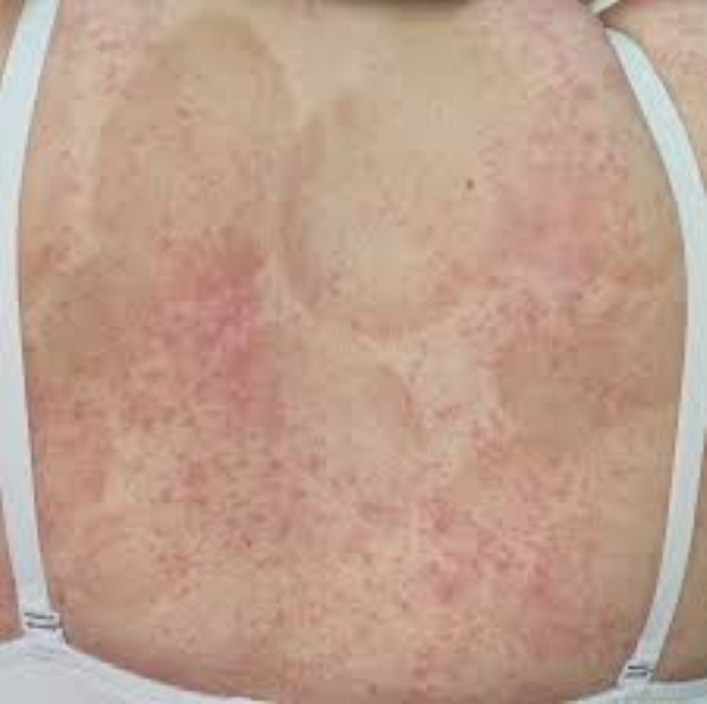 Dərman allergiyası