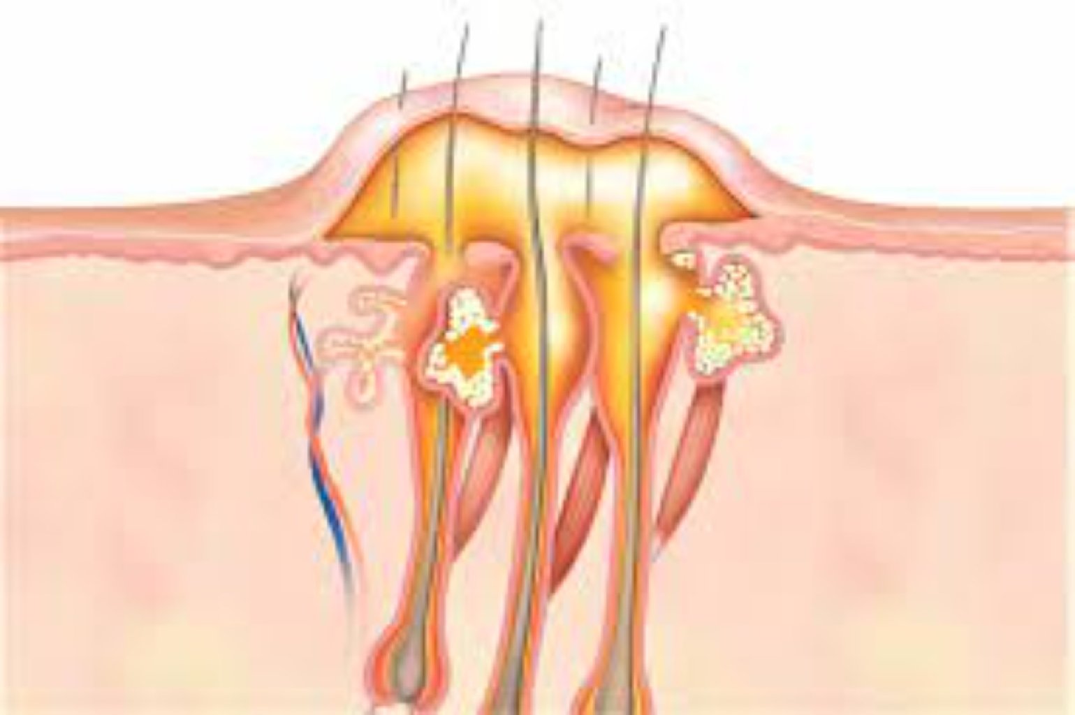 Yumsaq toxumalarin absesi