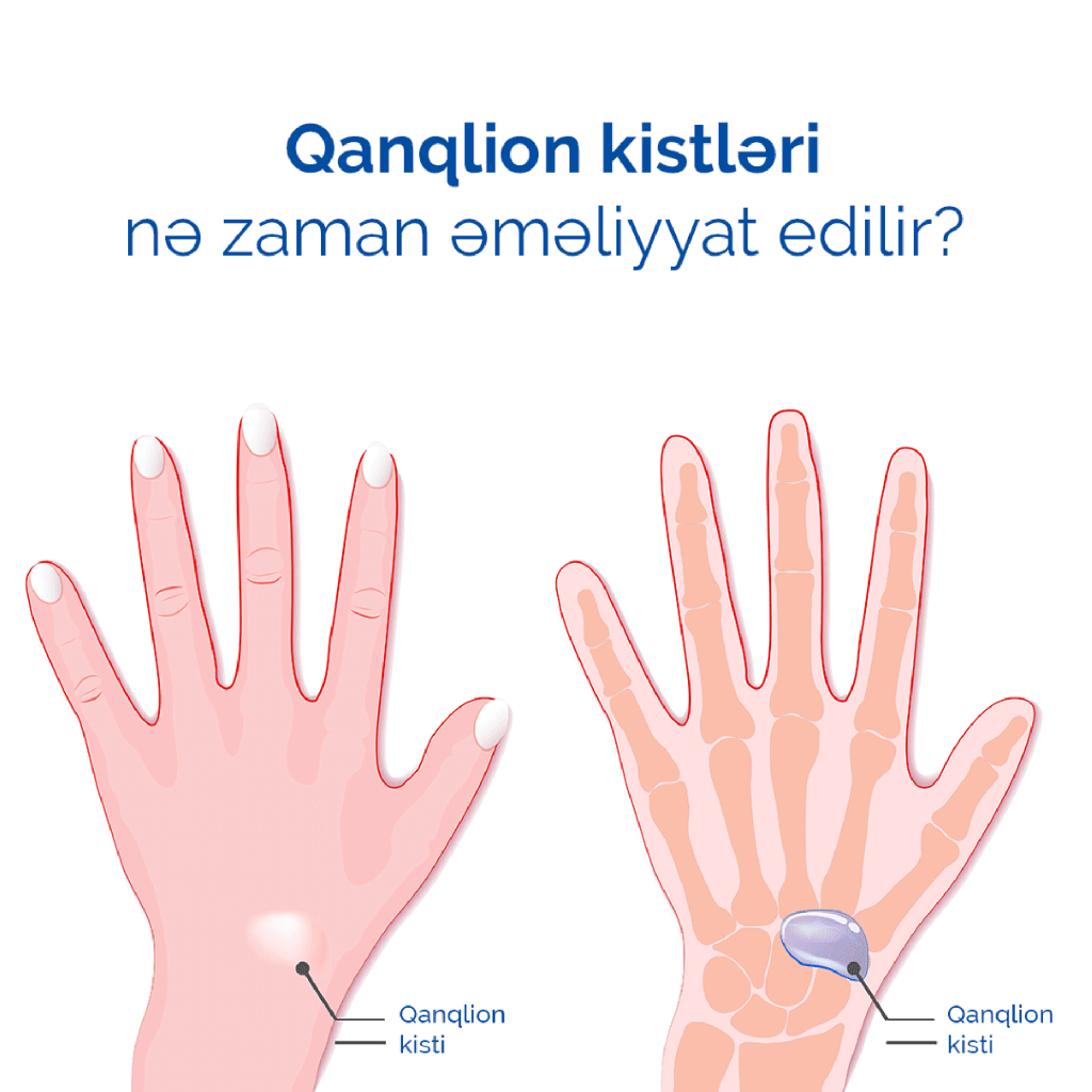 Qanqlion kistləri