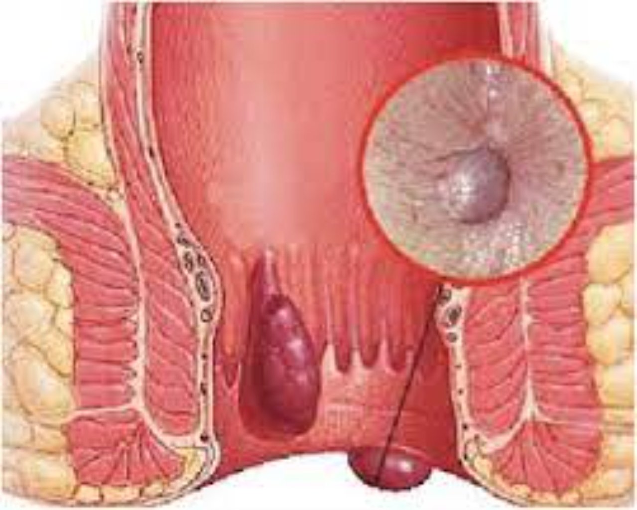 Anal sfinkterin çatismazligi