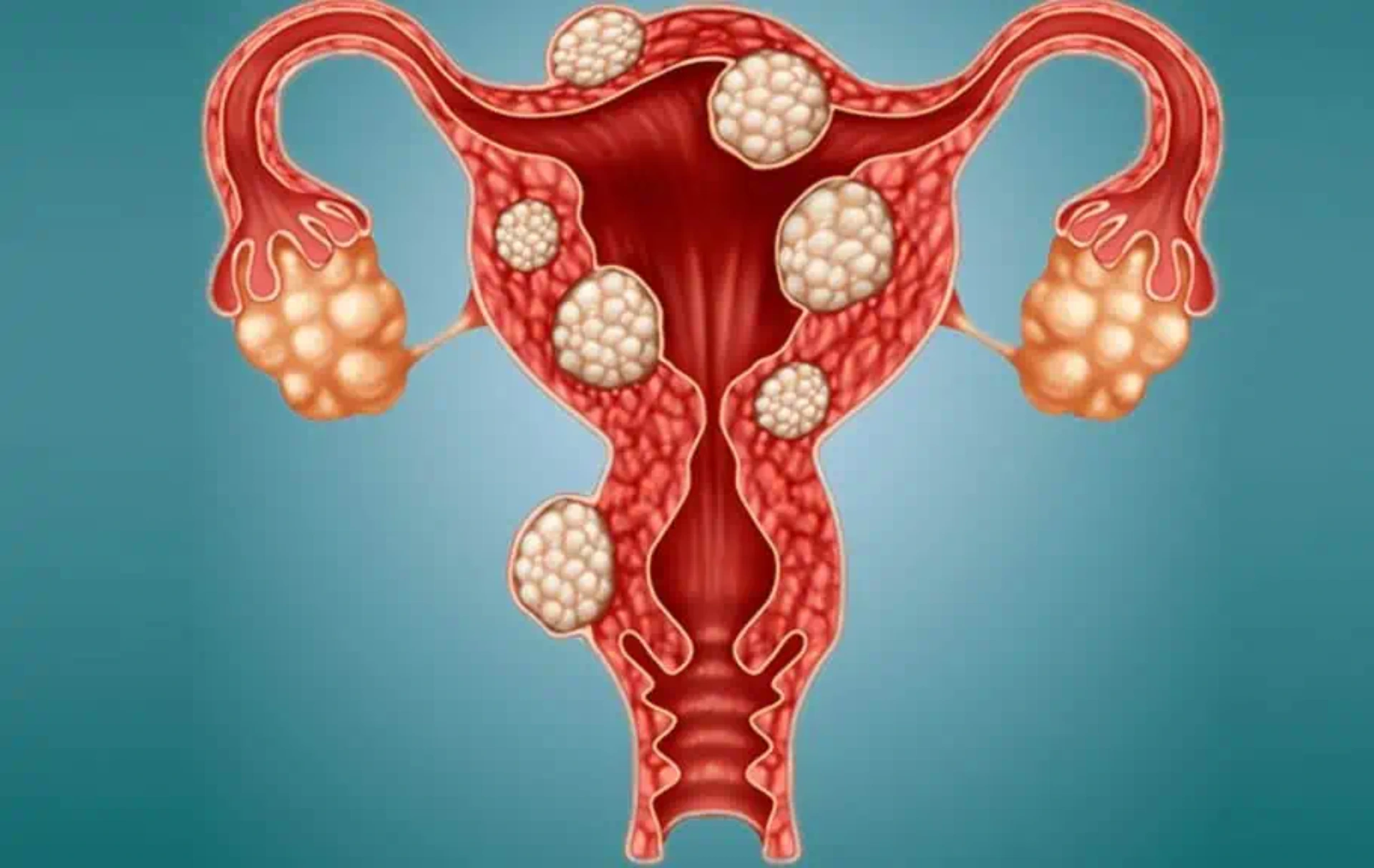 Yumurtalıq kistaları: diaqnoz, müalicə və qarşısının alınması