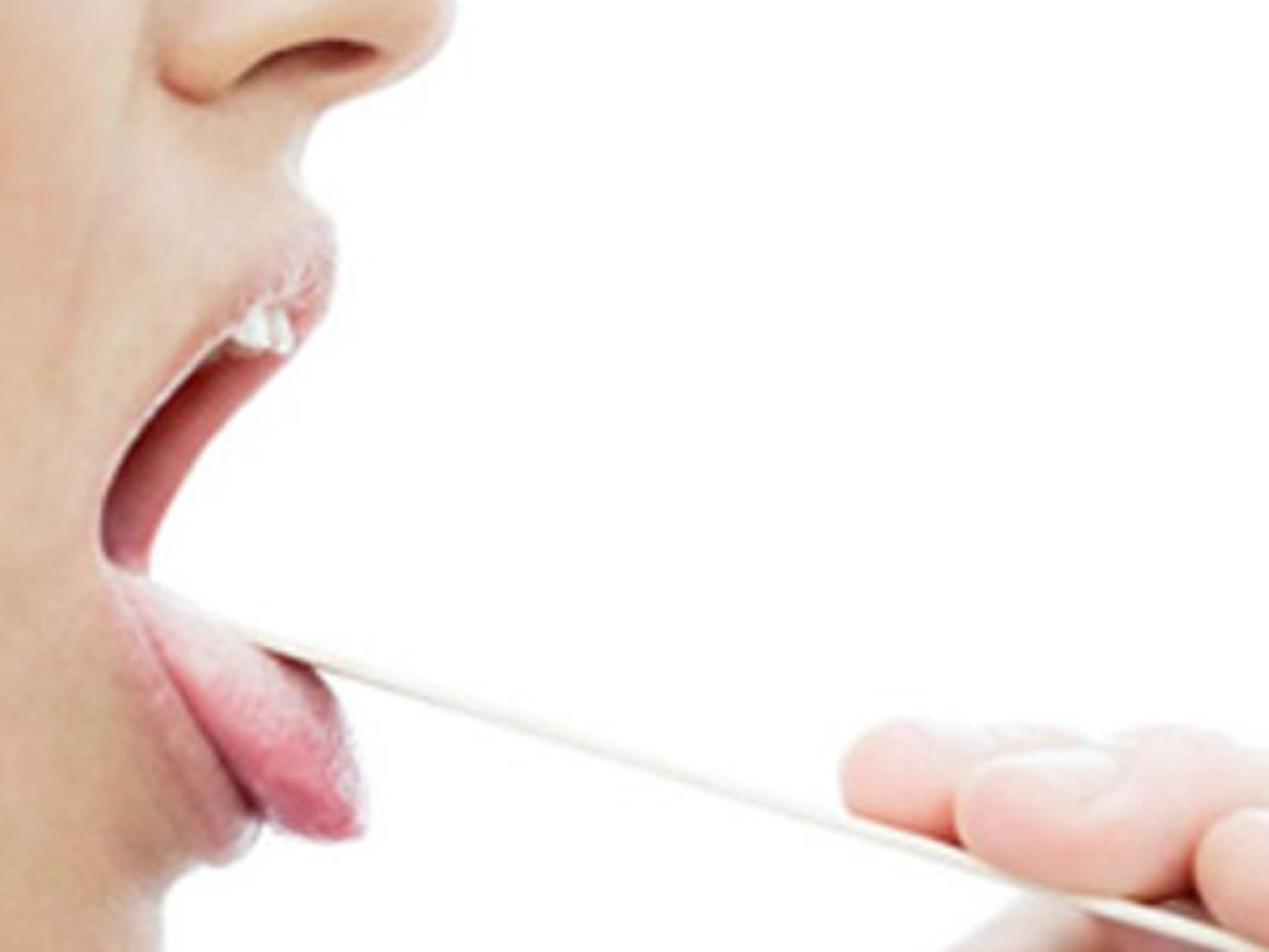 Kəskin faringit xəstəliyi