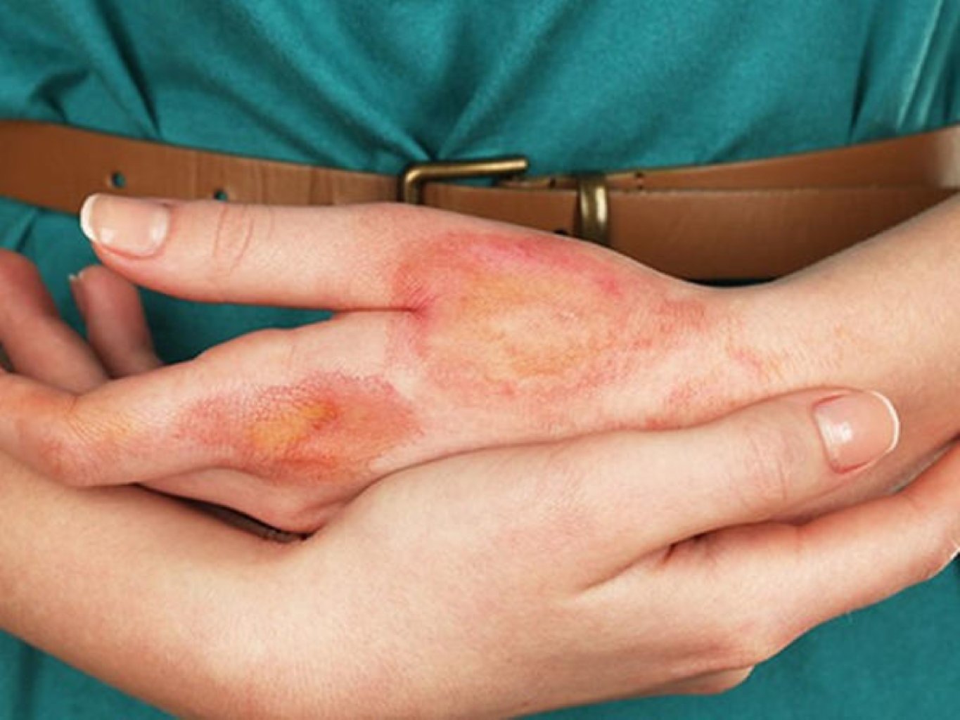 Uzunmüddətli sağalmayan yaraların müalicəsi