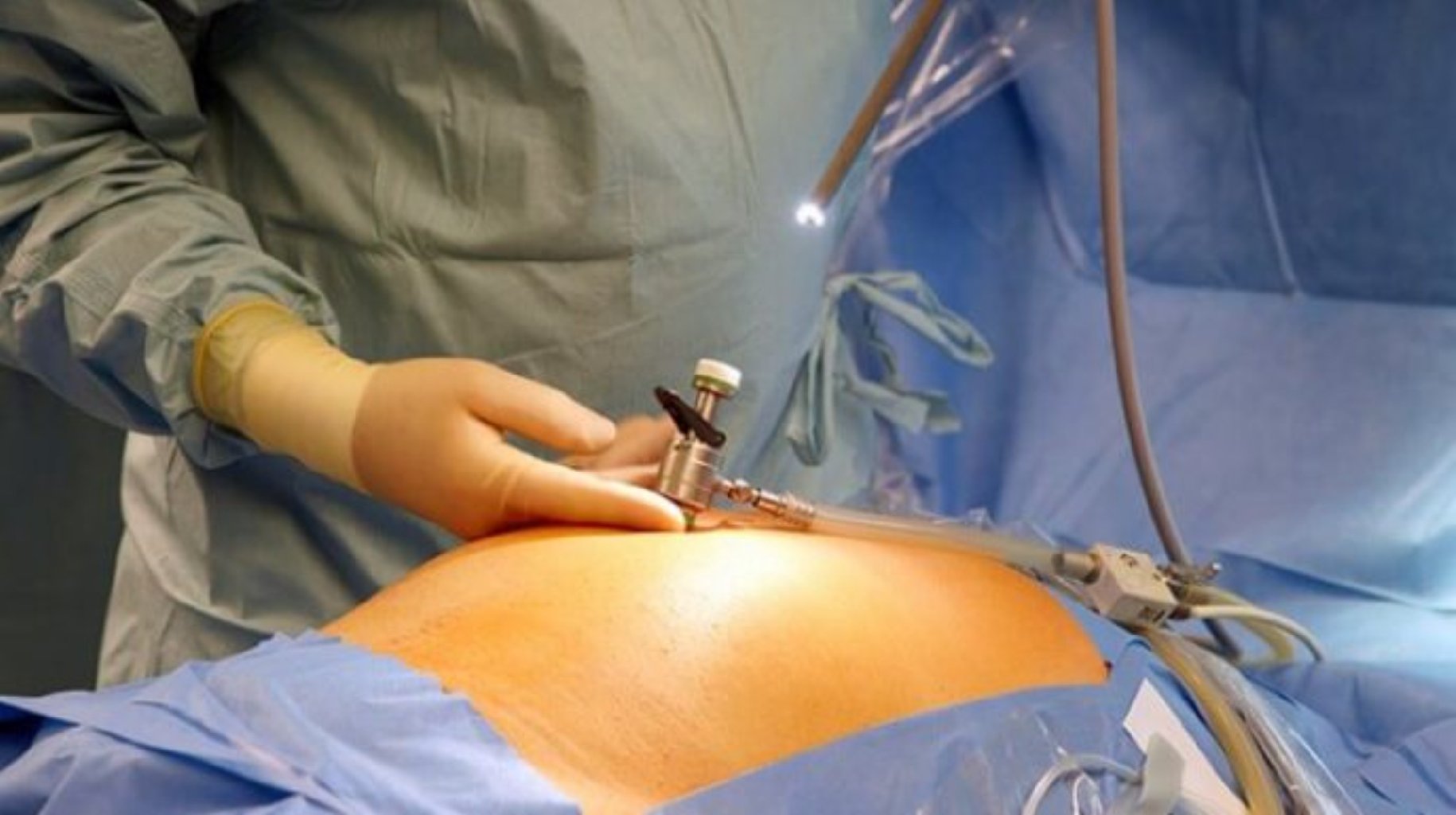 Laparoskopik və histereskopik əməliyyatlar