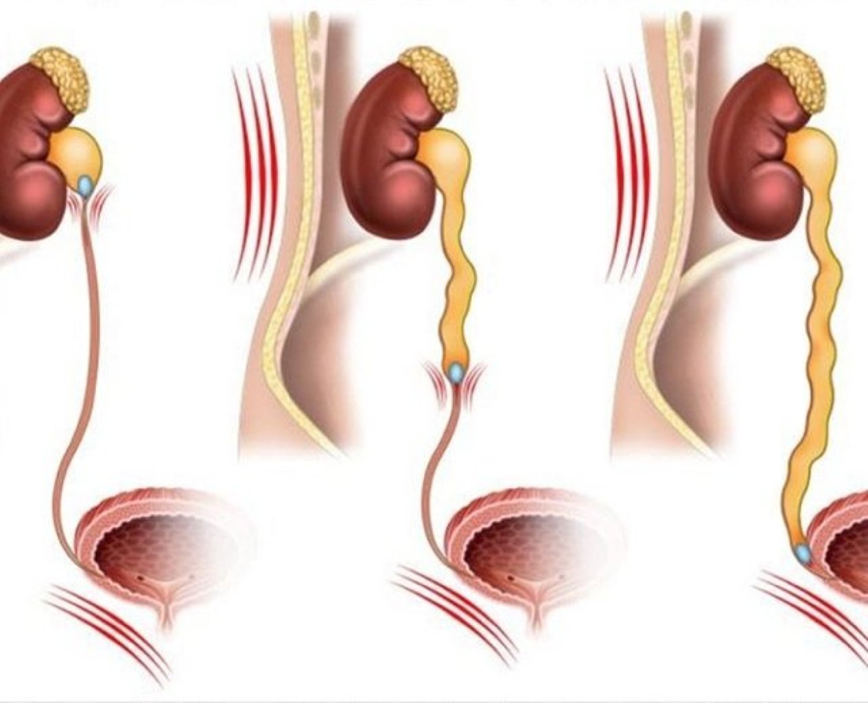 Böyrək Sancıları - Səbəbləri və Müalicəsi