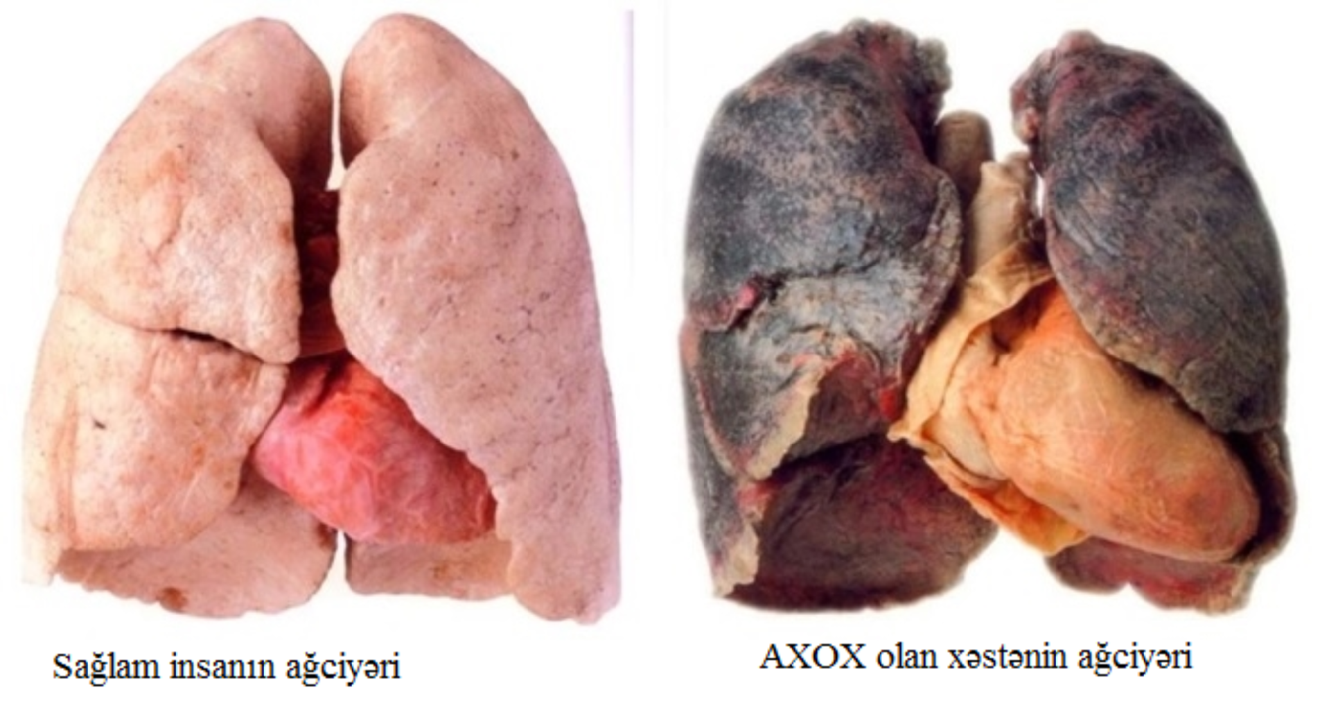 Ağciyərlərin xroniki obstruktiv xəstəliyi