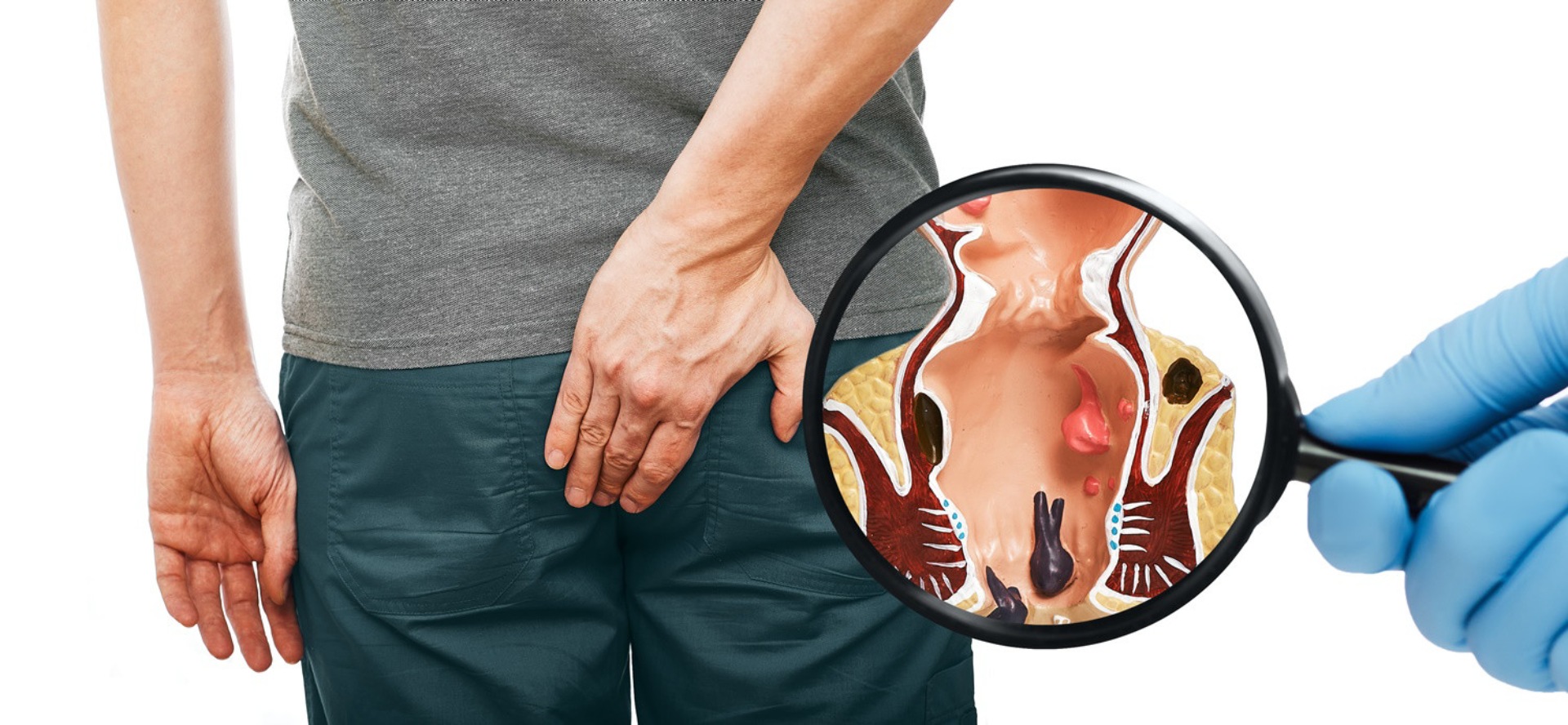 Hemoroid: simptomlar, səbəblər və müalicələr