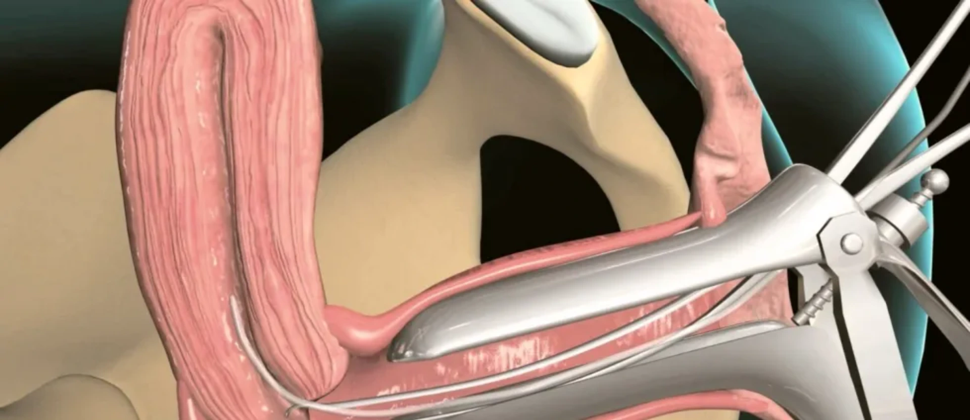 Endometrial biopsiya (pipel)