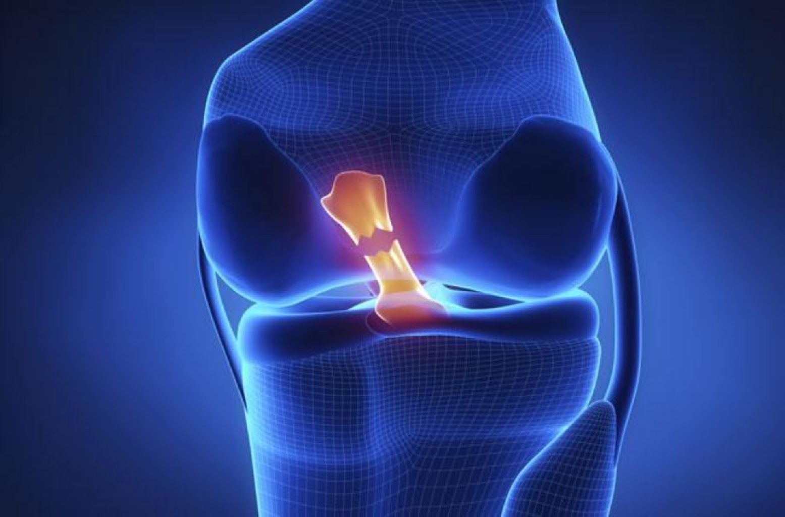 Çarpaz bağın qırılmasını necə başa düşmək olar? makalesi