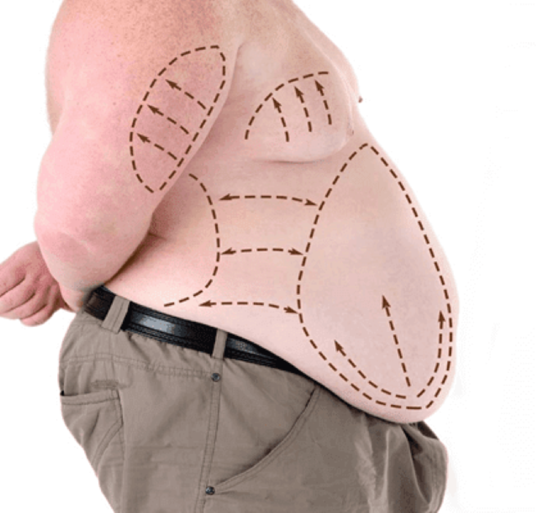 Piylənmənin Müalicəsi və Bariatrik Cərrahiyyə