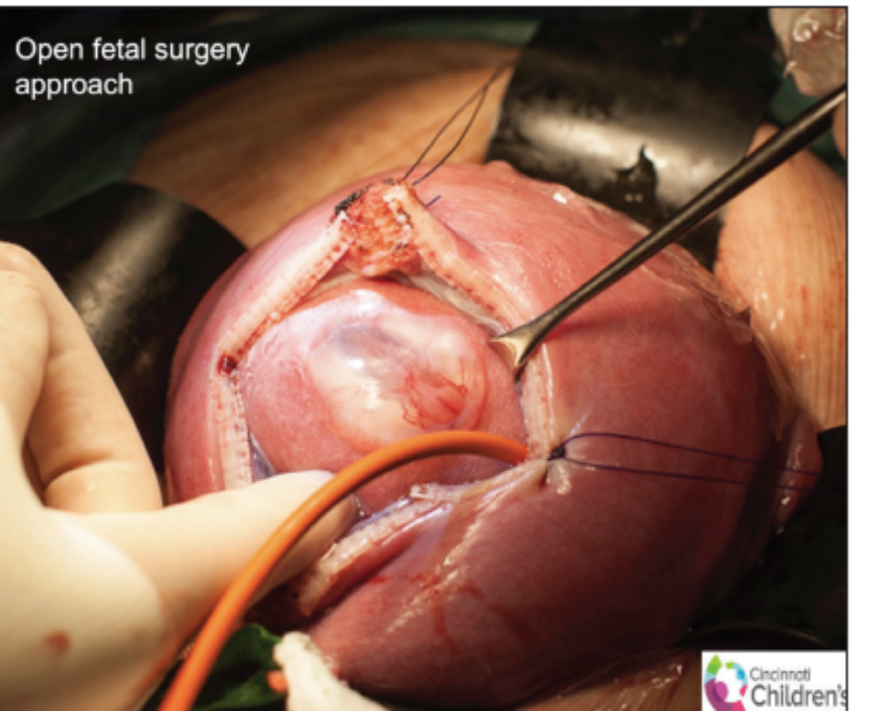 Fetal cərrahi müdaxilələr