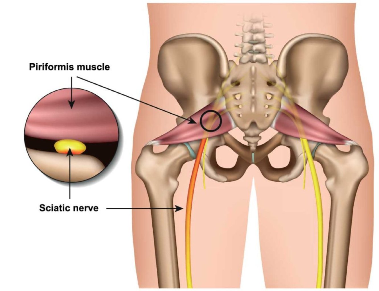 Piriformis Sindromu