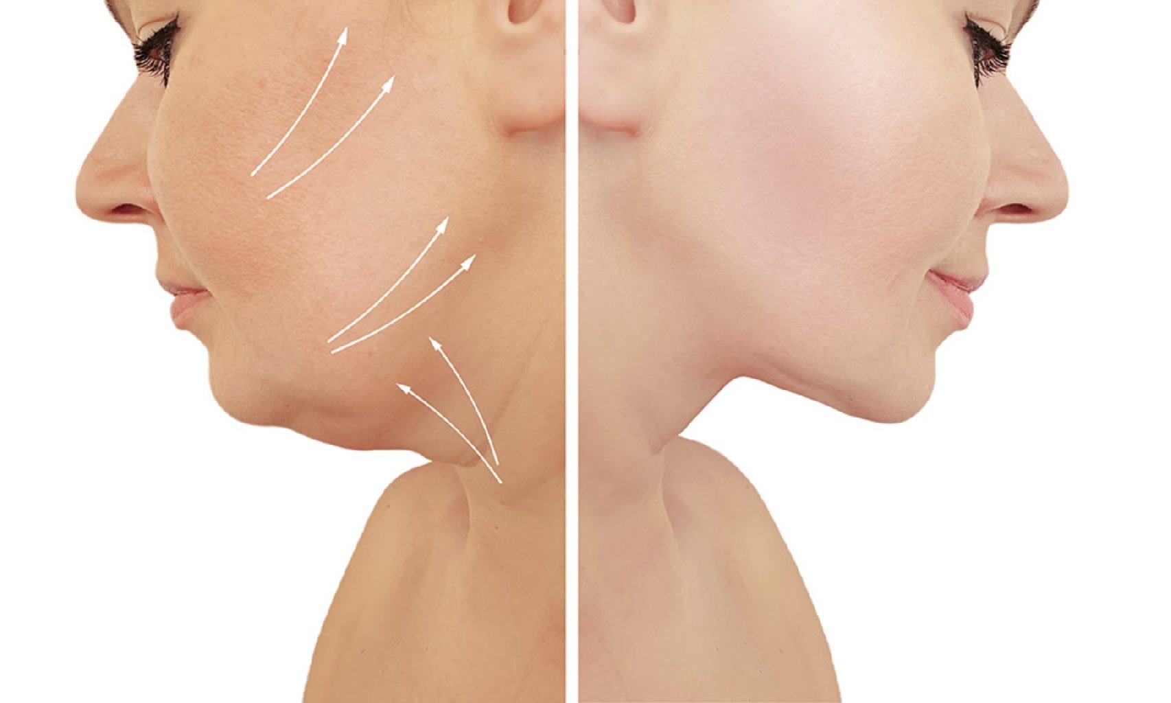 Boyun və Üz Liftinqi makalesi