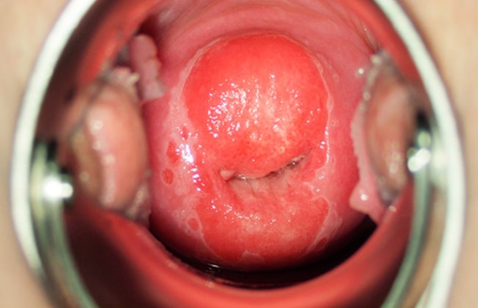 Uşaqlıq boynunun eroziyası