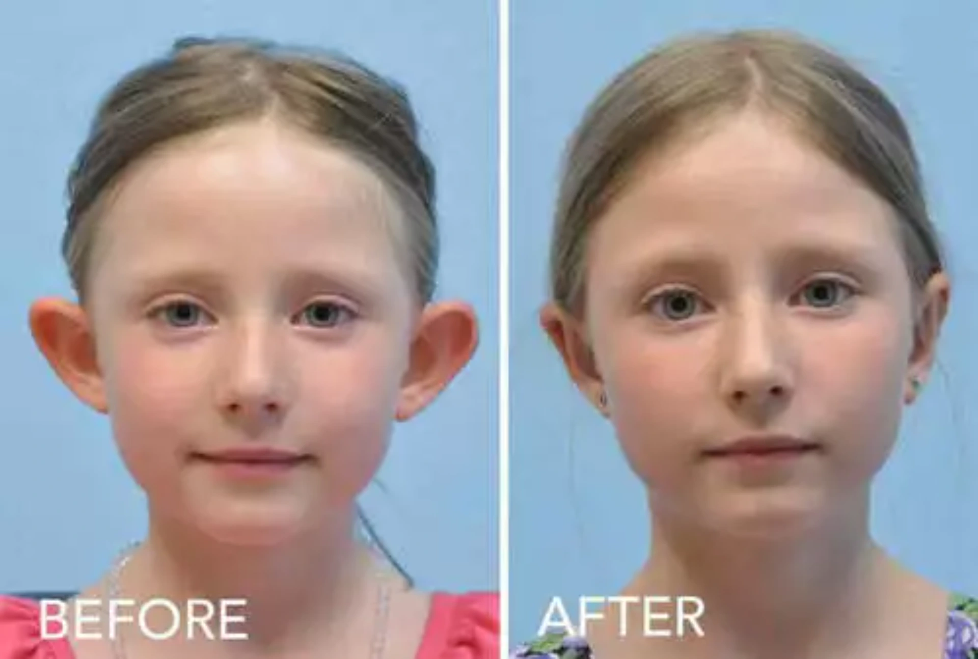 Qulaq Kulunun Estetikası Otoplastika