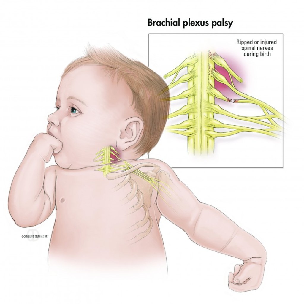 Anadangəlmə qol iflici makalesi