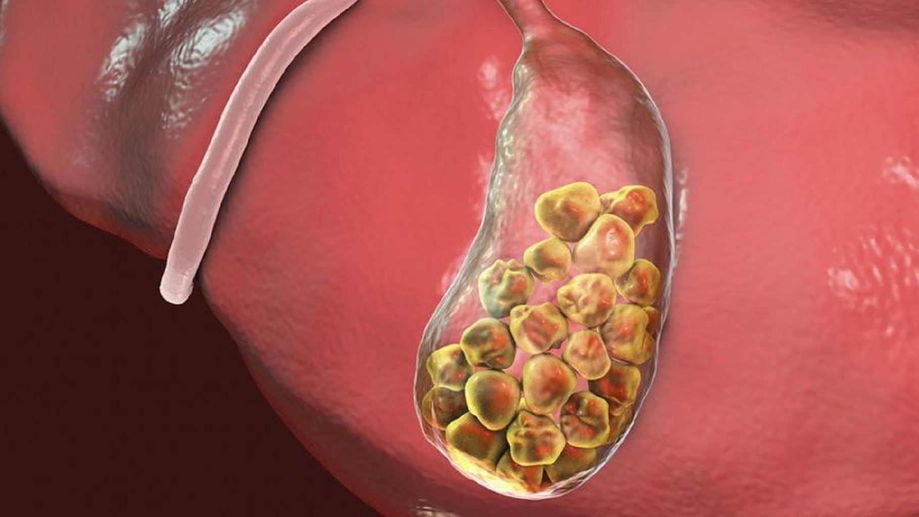 Öd Kisəsində Ağrı və Narahatlıq: Səbəbləri, Simptomları və Müalicə Yolları