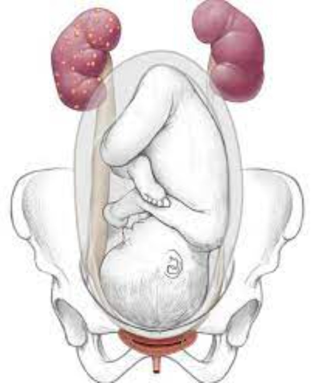 Hestasion pielonefrit