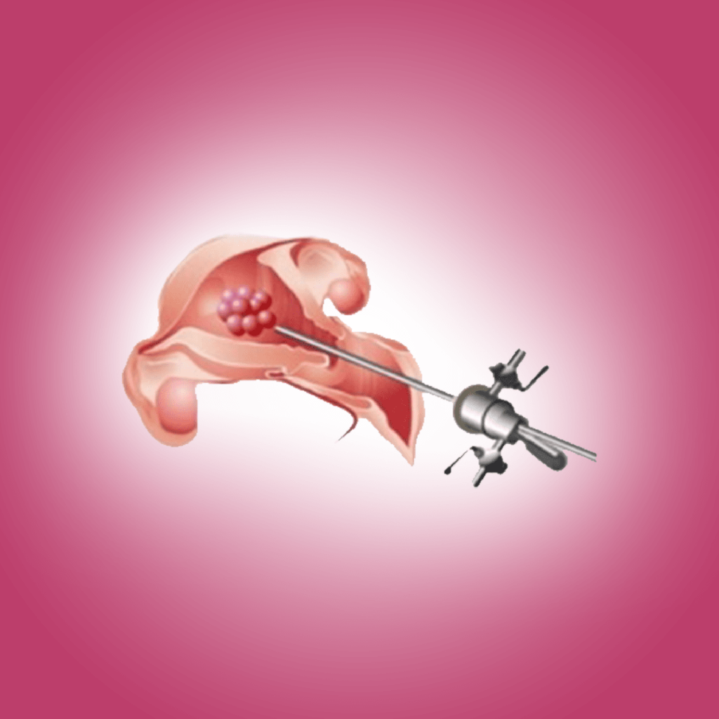 Operativ (cərrahi) histeroskopiya