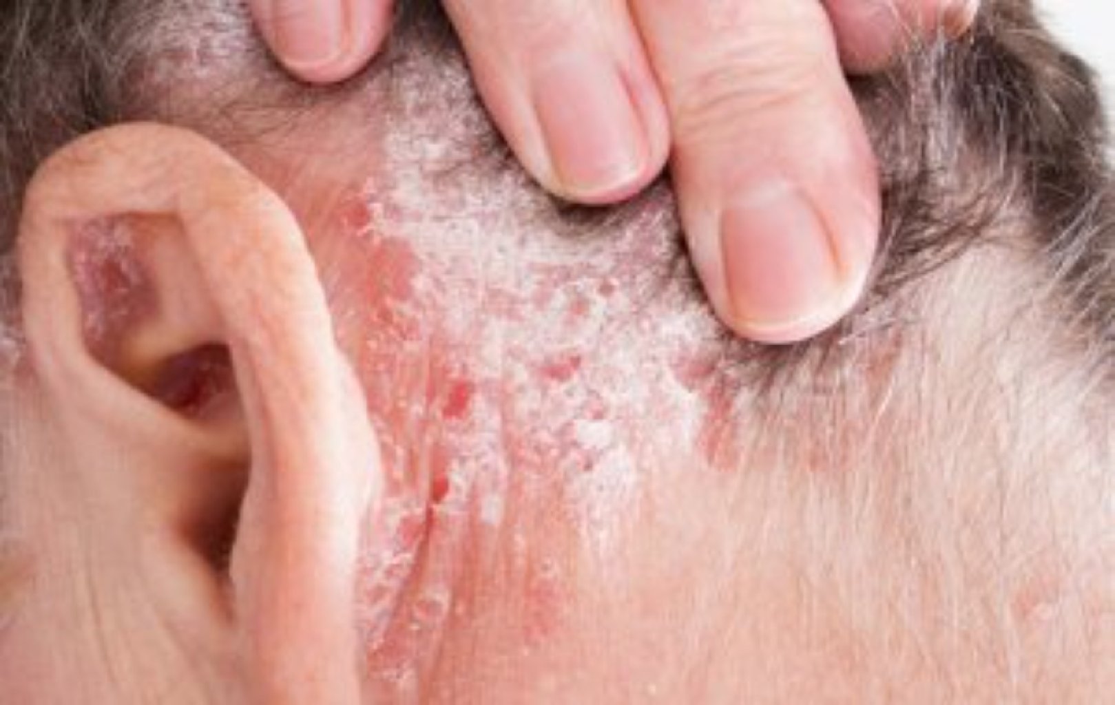 Seboreyanın səbəbləri