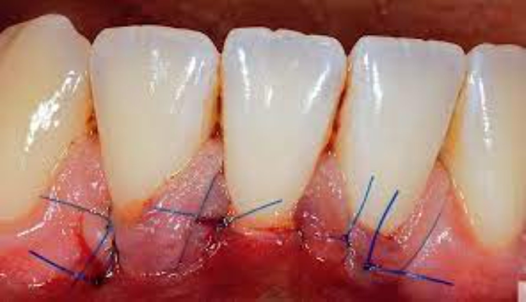 Estetik diş əti səviyyələndirilməsi və s.