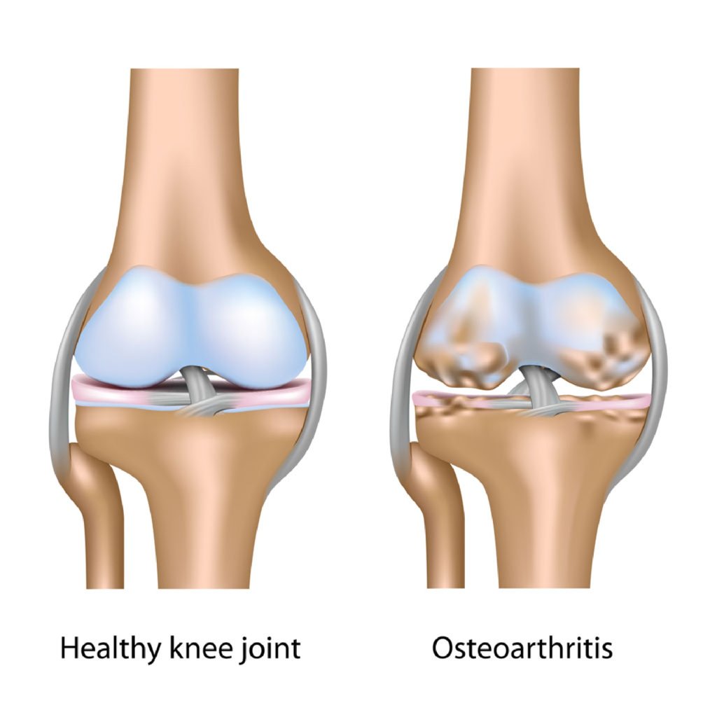 Osteoartrit və omba protezləri makalesi