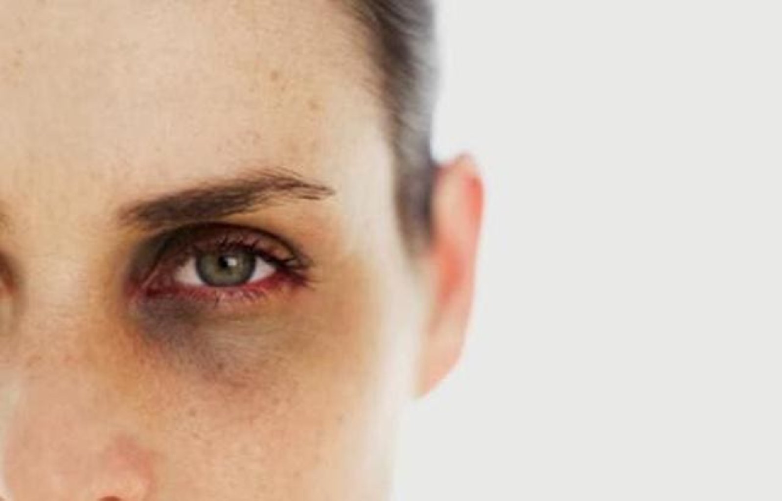 Göz altı kölgələrin yaranma səbəbləri nələrdir?