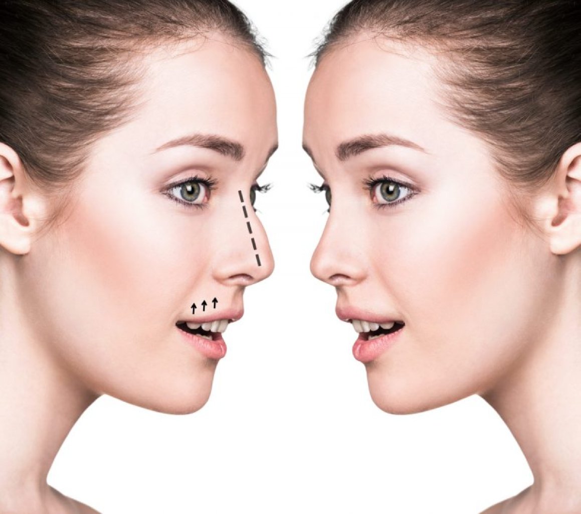 Adenoid-Tonsil Cərrahisi