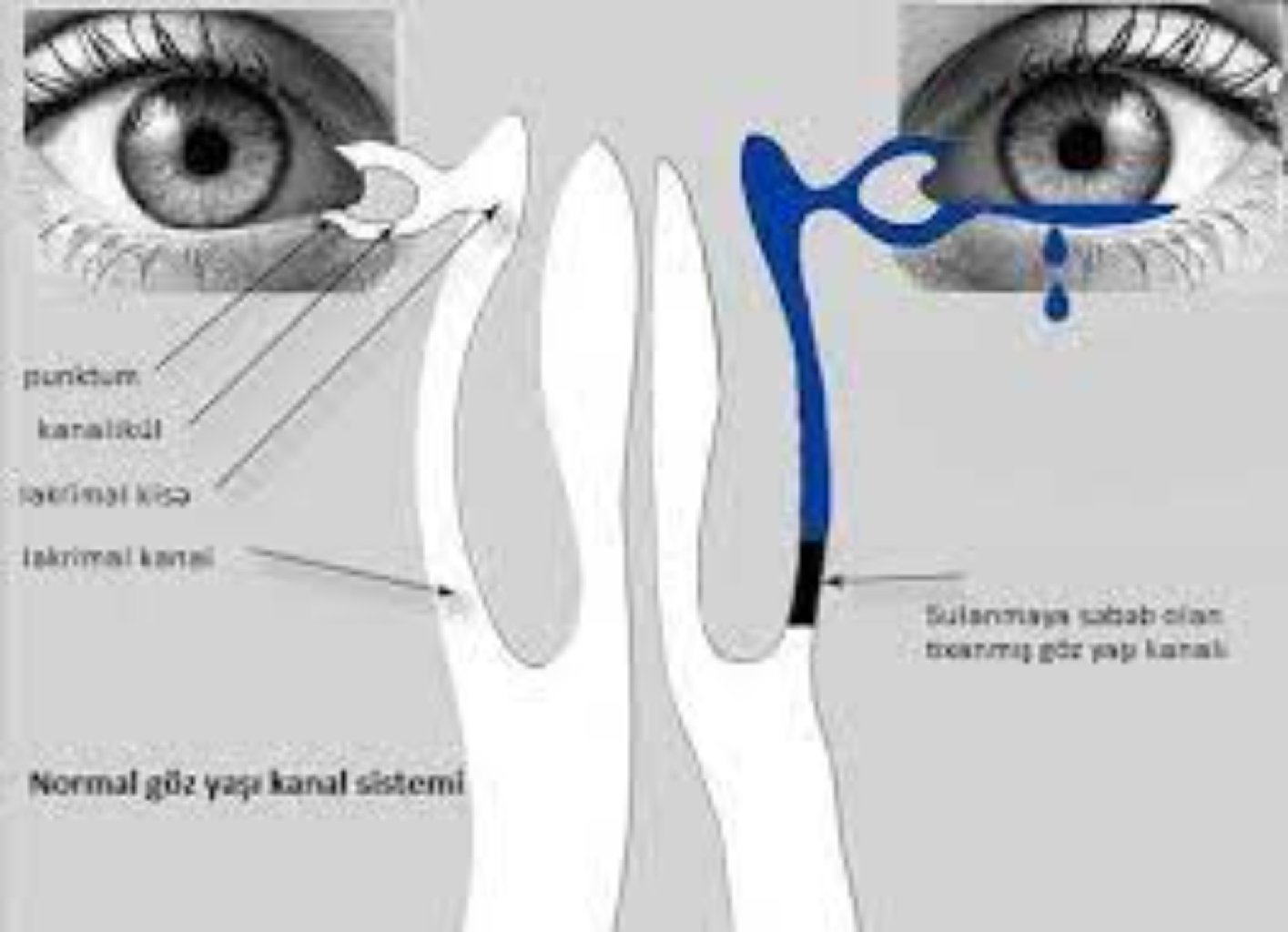 Gözyaşı kanalı tıxanıqlığı